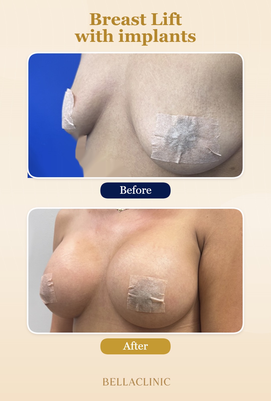 Breast Lift with implants