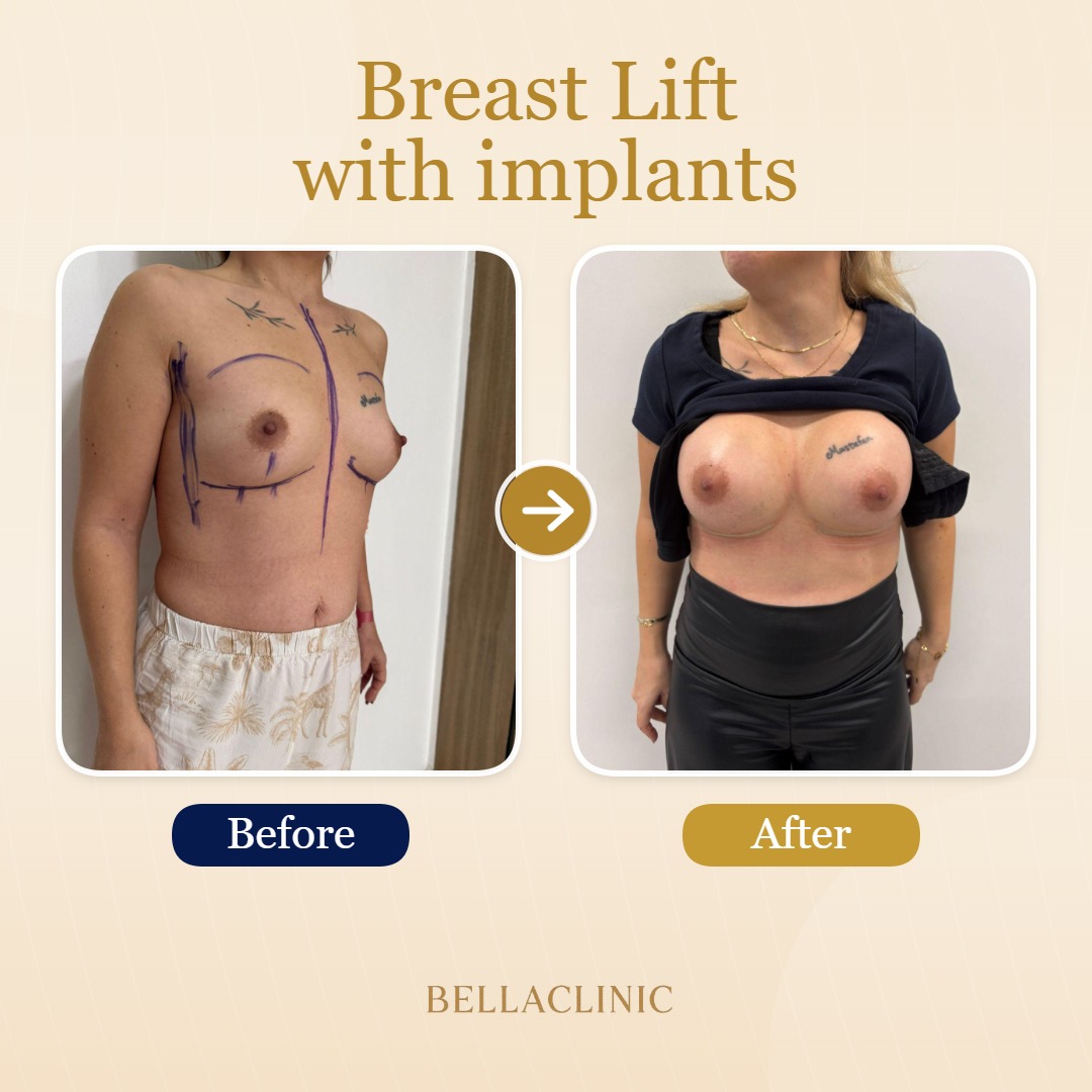 Breast Lift with implants