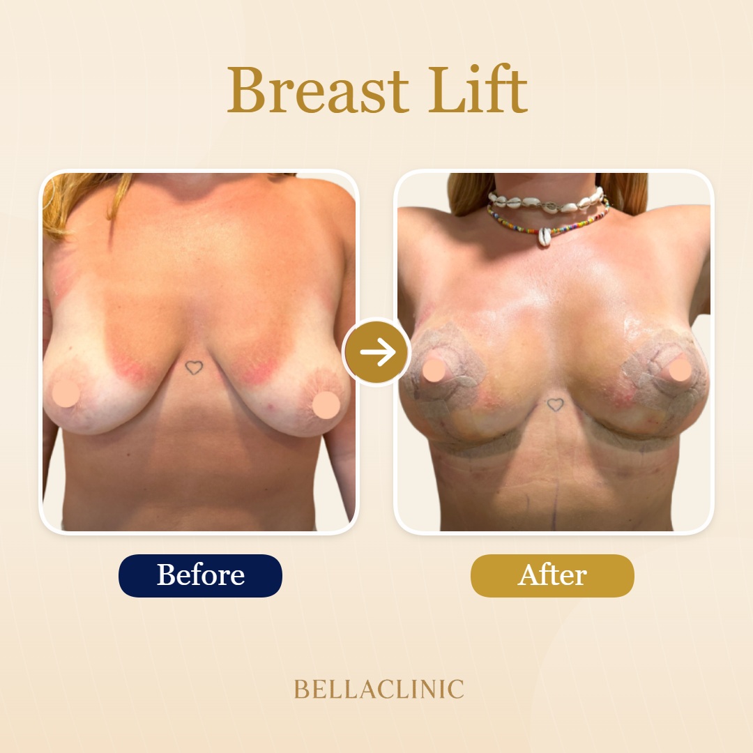 Breast Lift