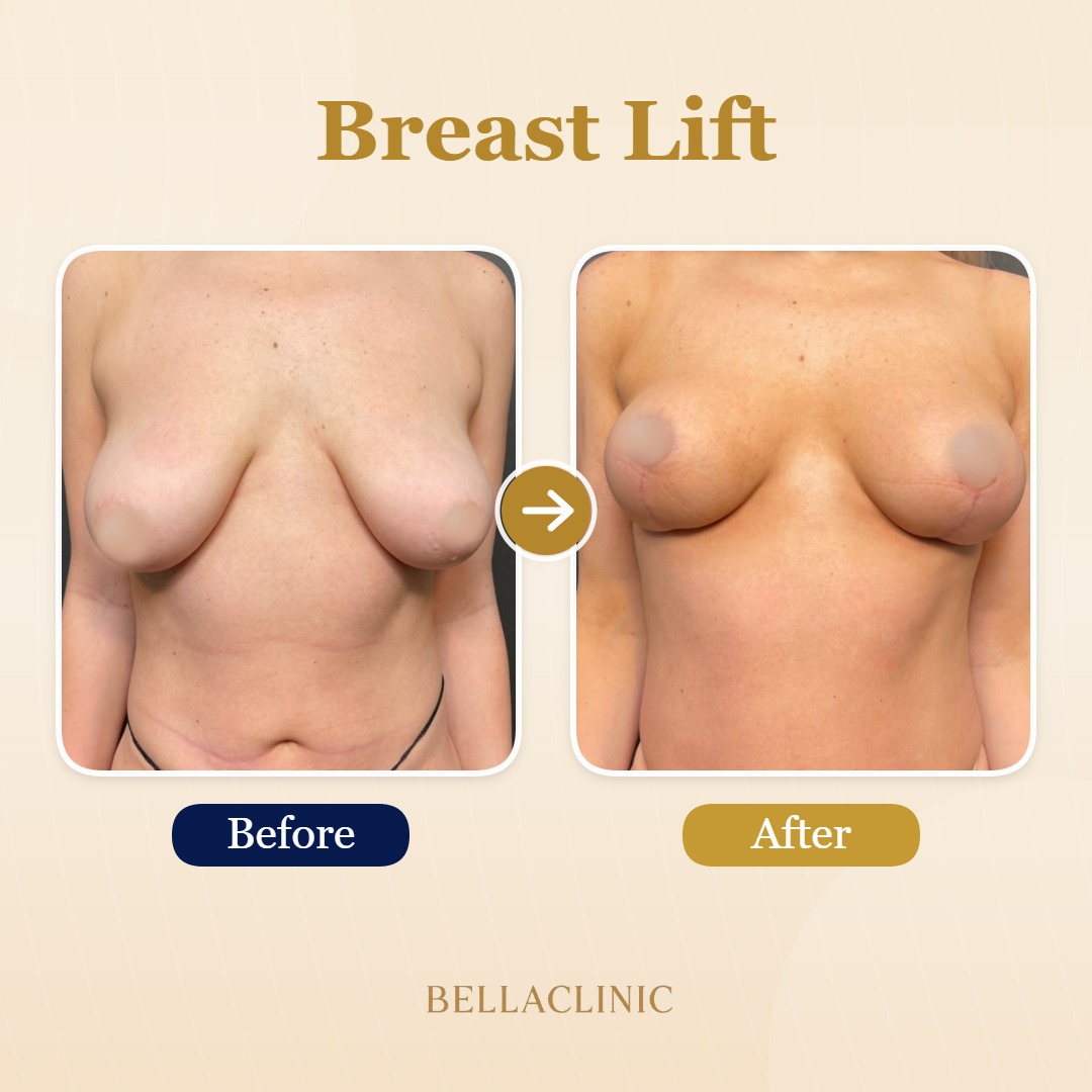 before-after-20260720-171342-QNQBQ2.jpg
