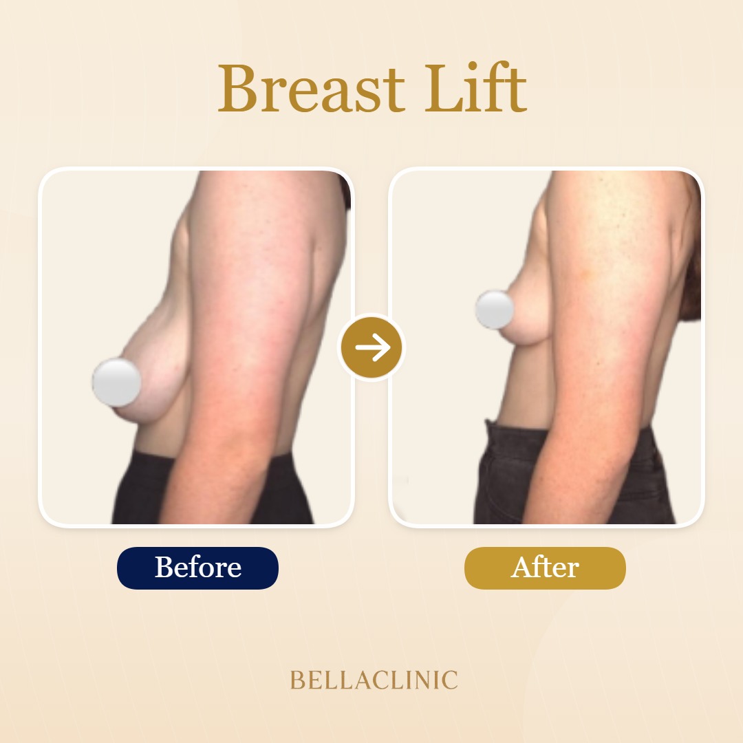 Breast Lift