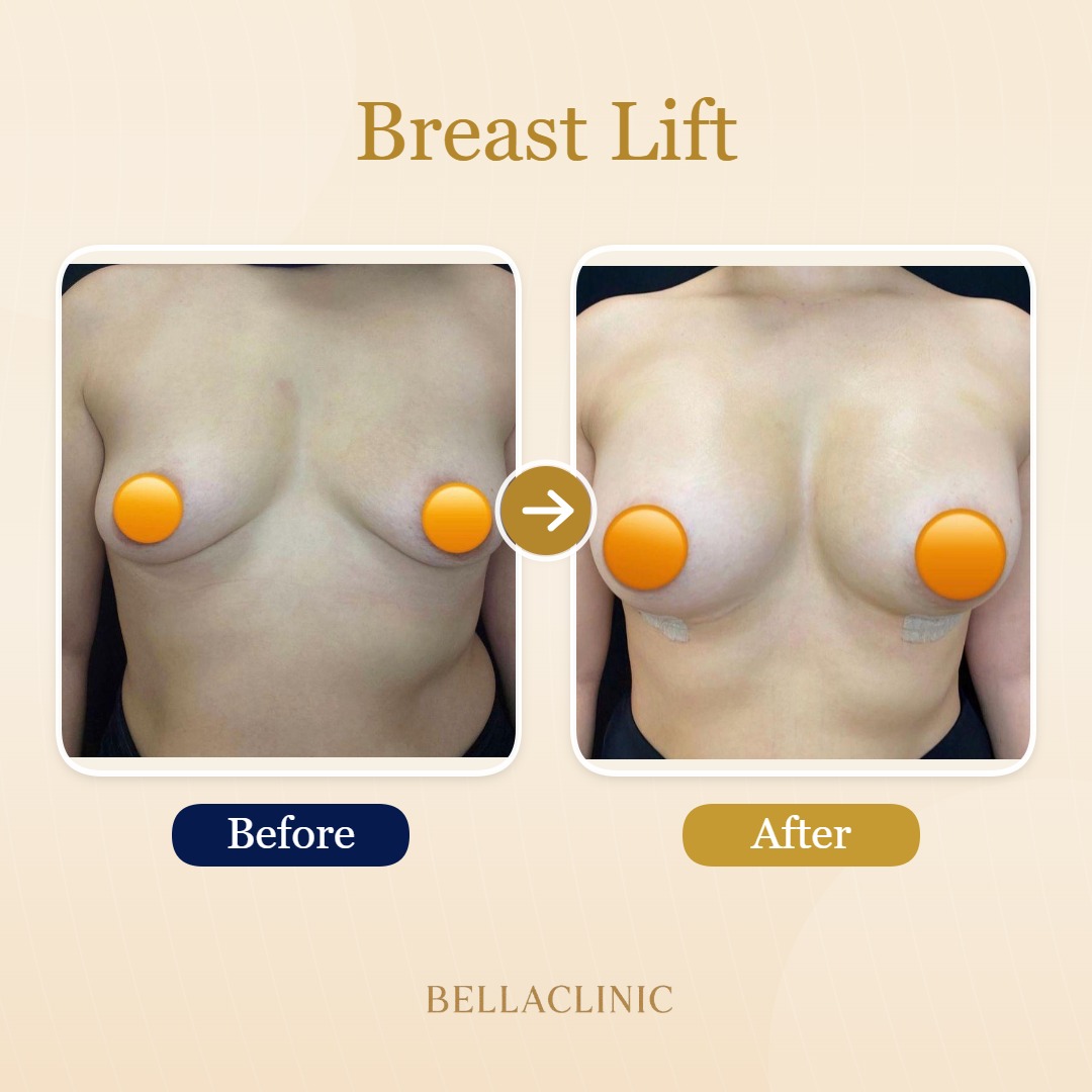 Breast Lift