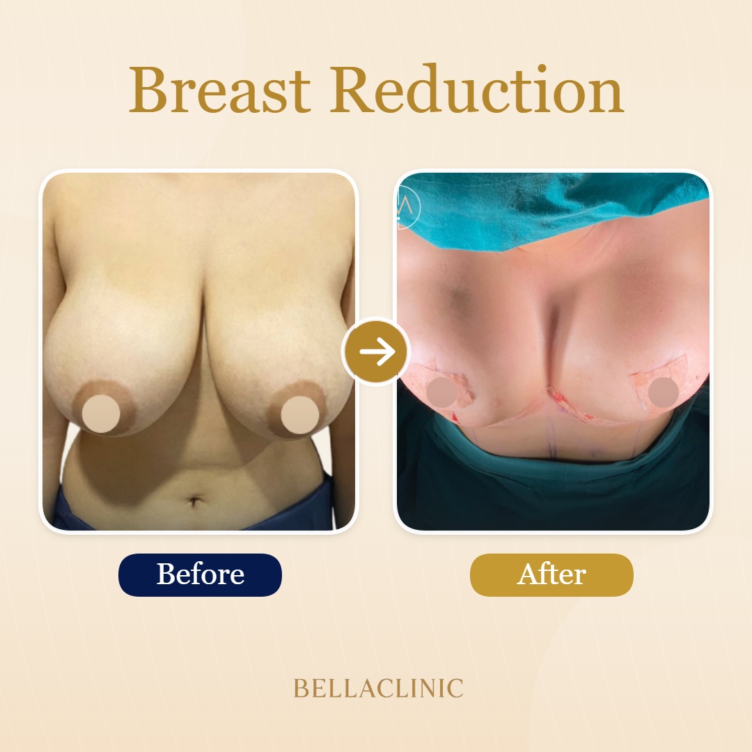 before-after-20260611-145731-AdTEpu.jpg