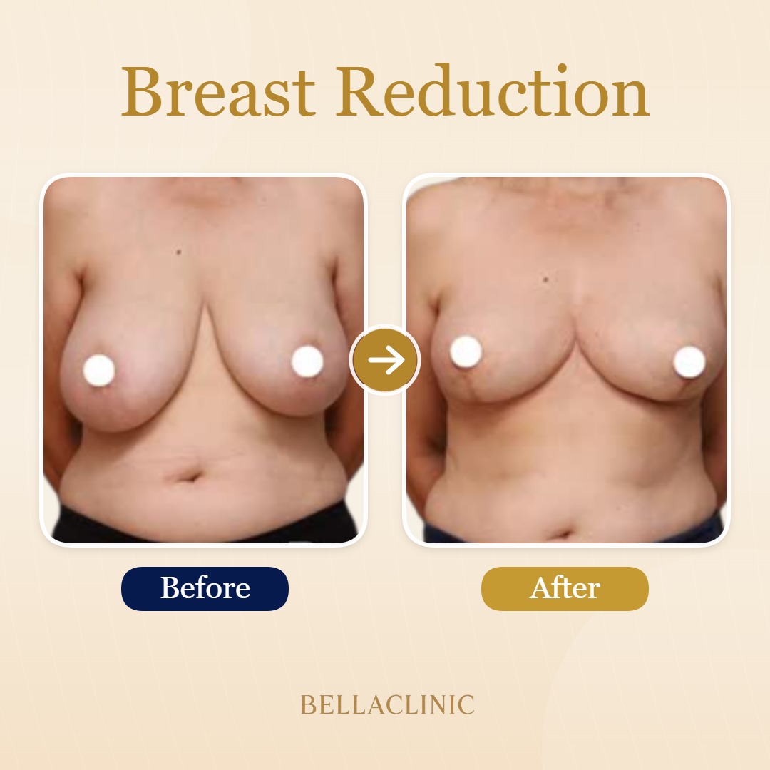 Breast Reduction