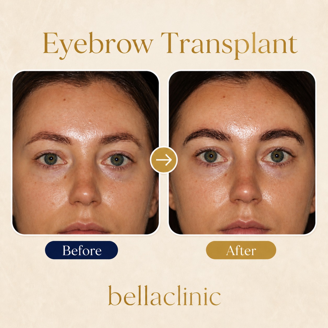 Brow Lift