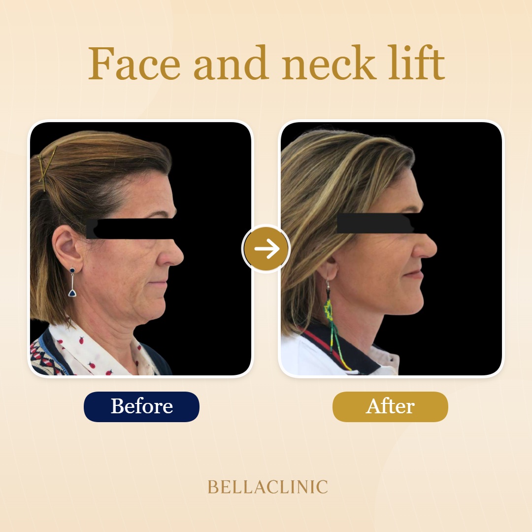 Face and neck lift