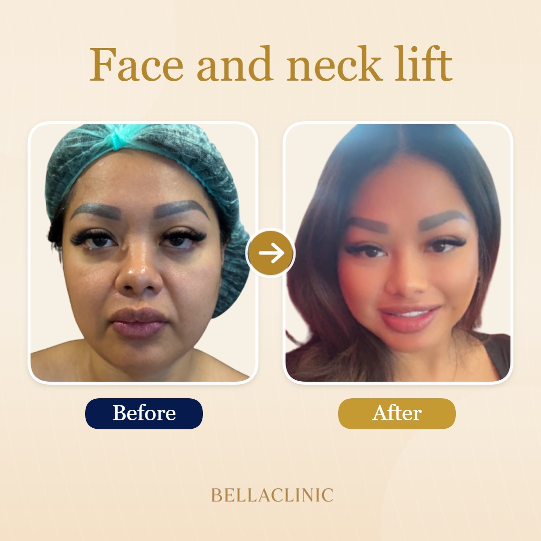 Face and neck lift