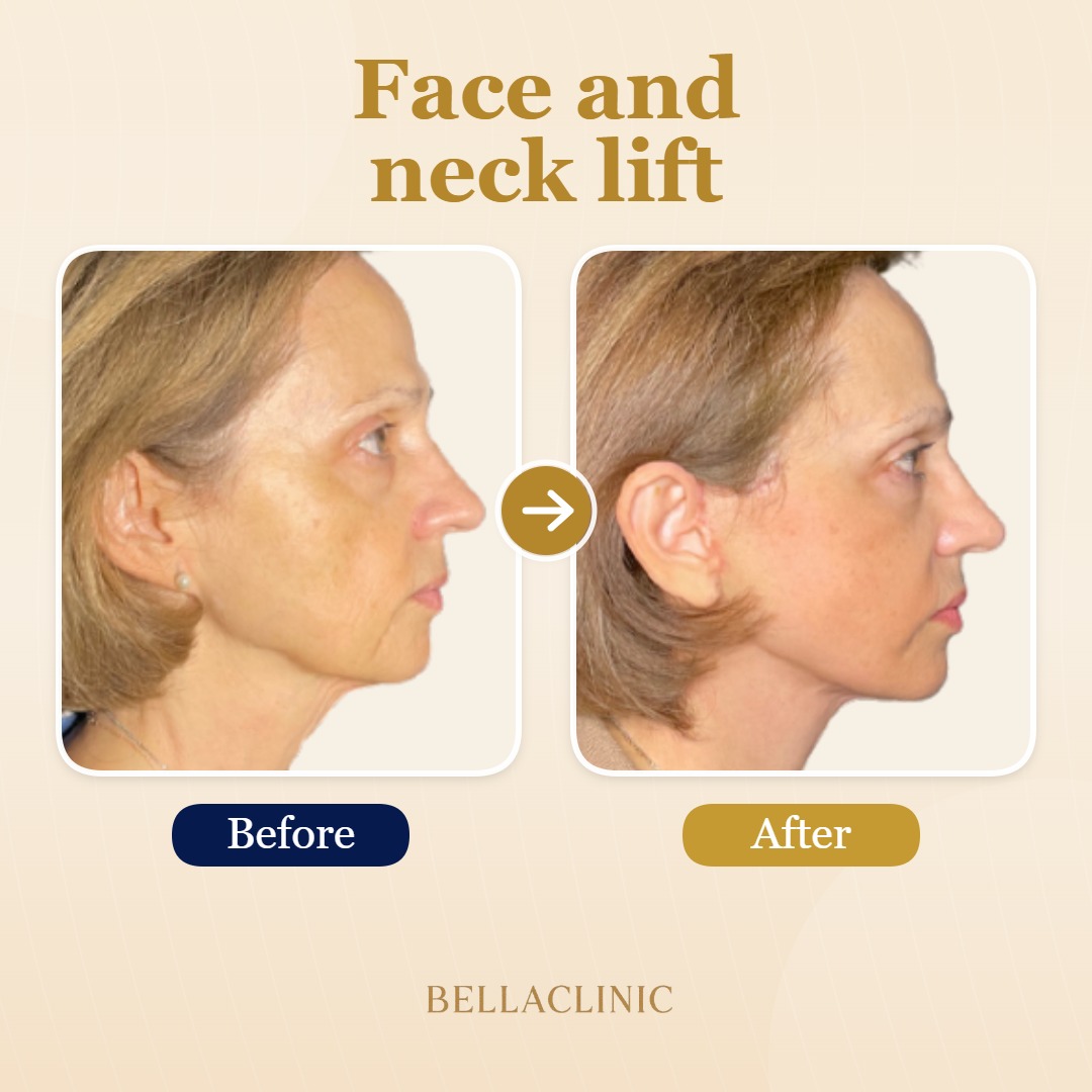 before-after-20260720-172736-cJDmeJ.jpg