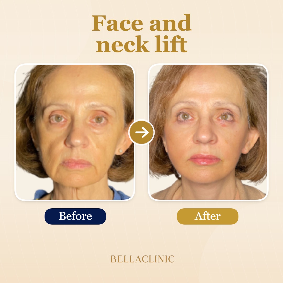 before-after-20260720-172917-rg6wqL.jpg