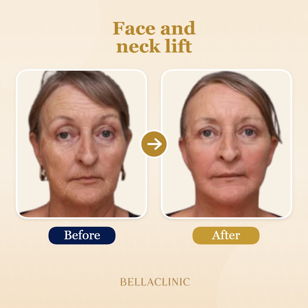 Face and neck lift
