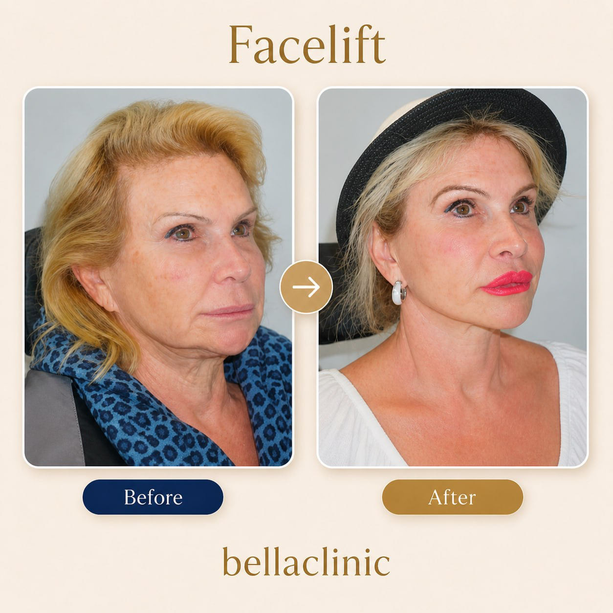 Facelift