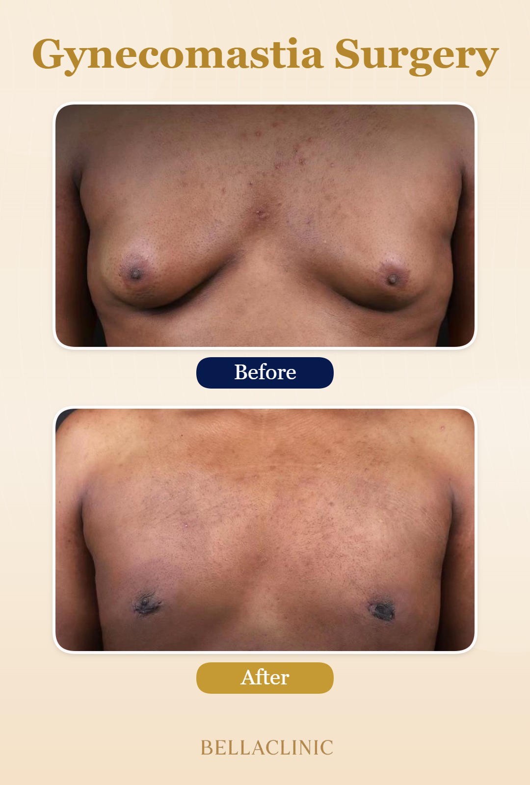 Gynecomastia Surgery