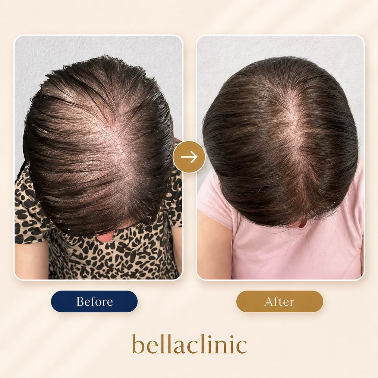 Hair Transplant