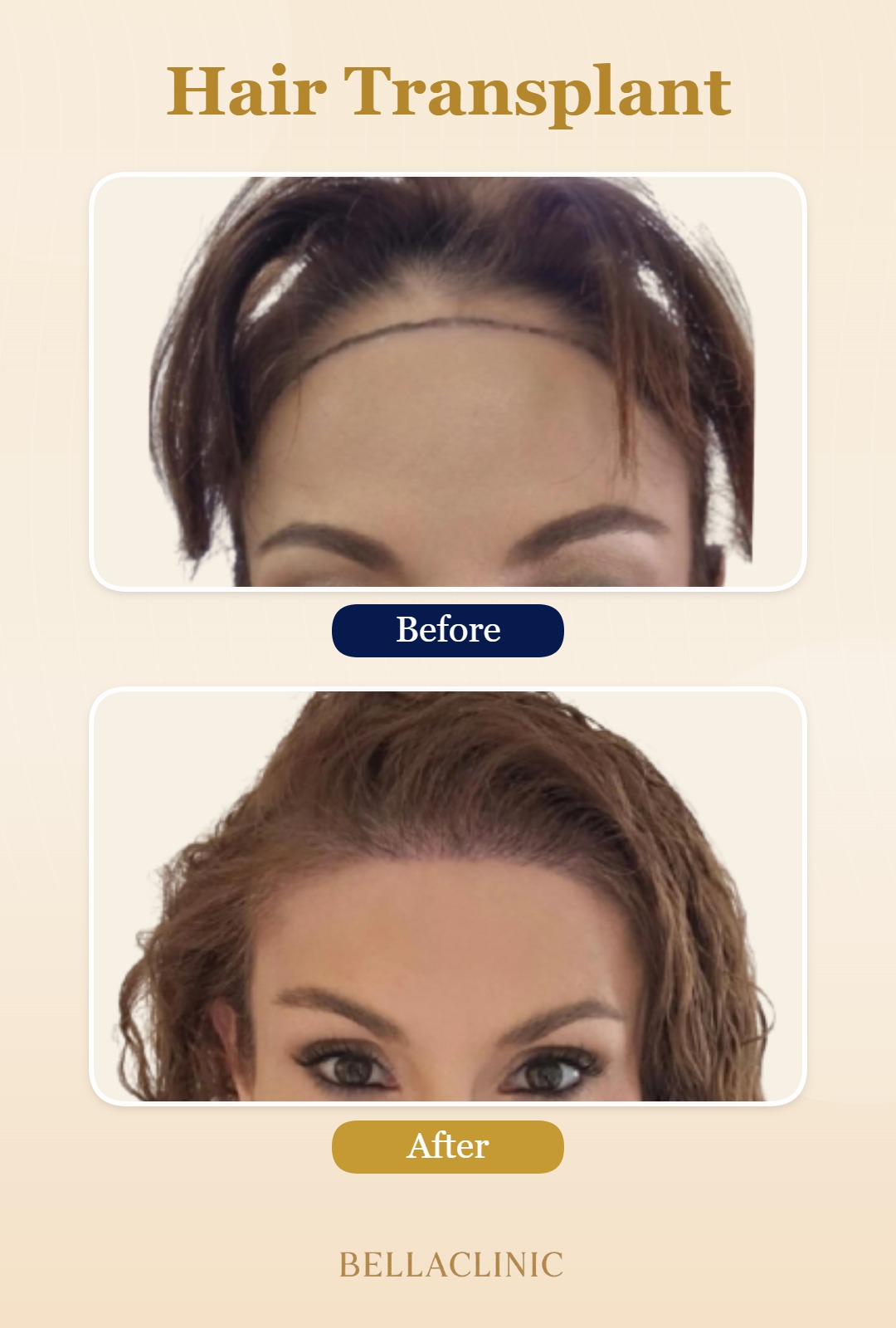 Hair Transplant