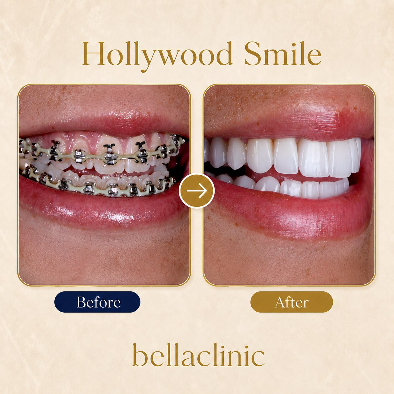 Hollywood Smile