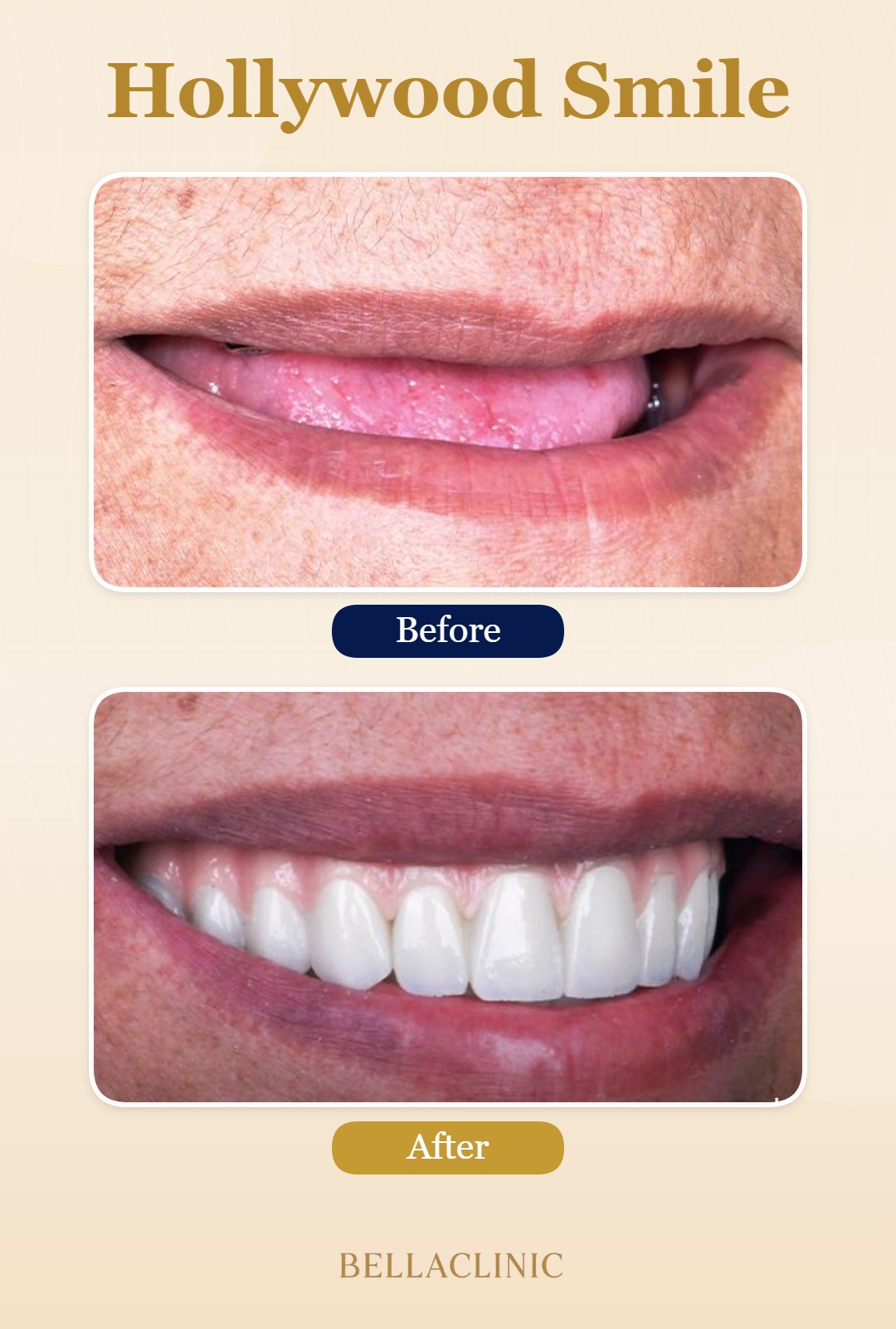 Hollywood Smile