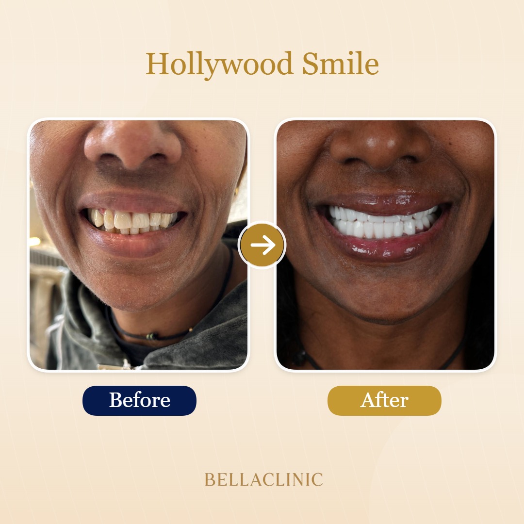 Hollywood Smile