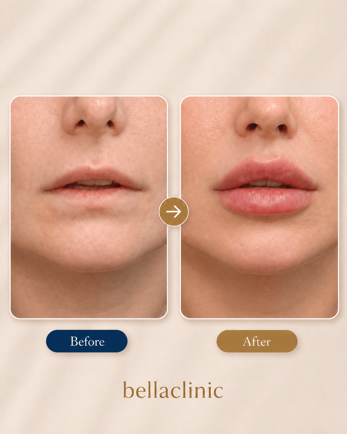 Lip Lift