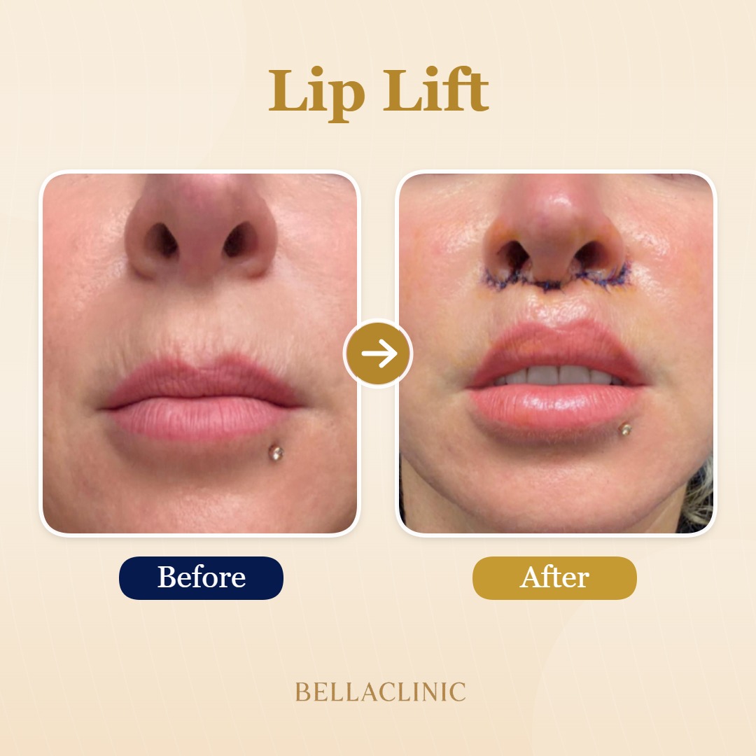 Lip Lift