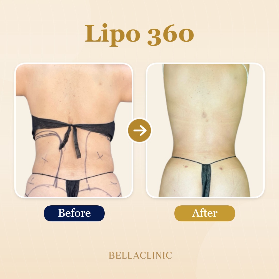 Lipo 360