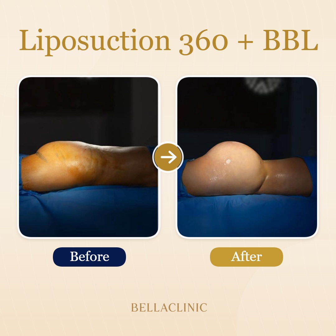 before-after-20260710-152430-ZfoTCg.jpg