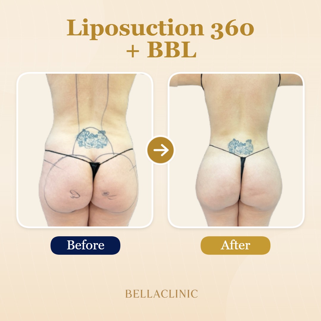 Liposuction 360 + BBL