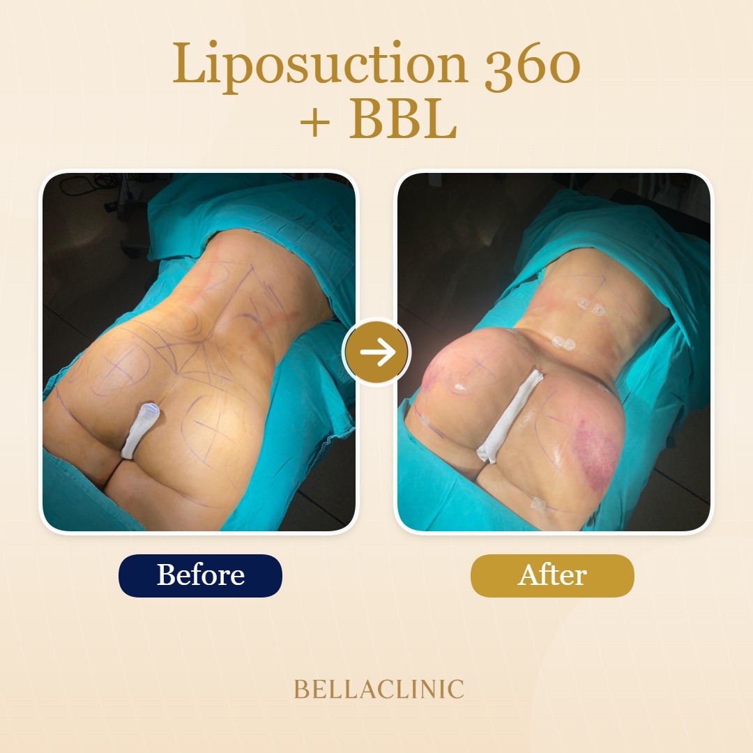 Liposuction 360 + BBL