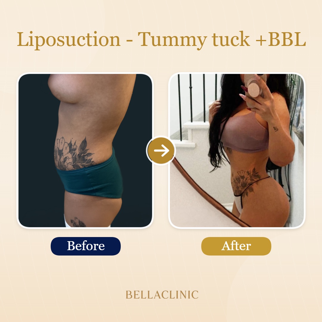 Liposuction - Tummy tuck +BBL