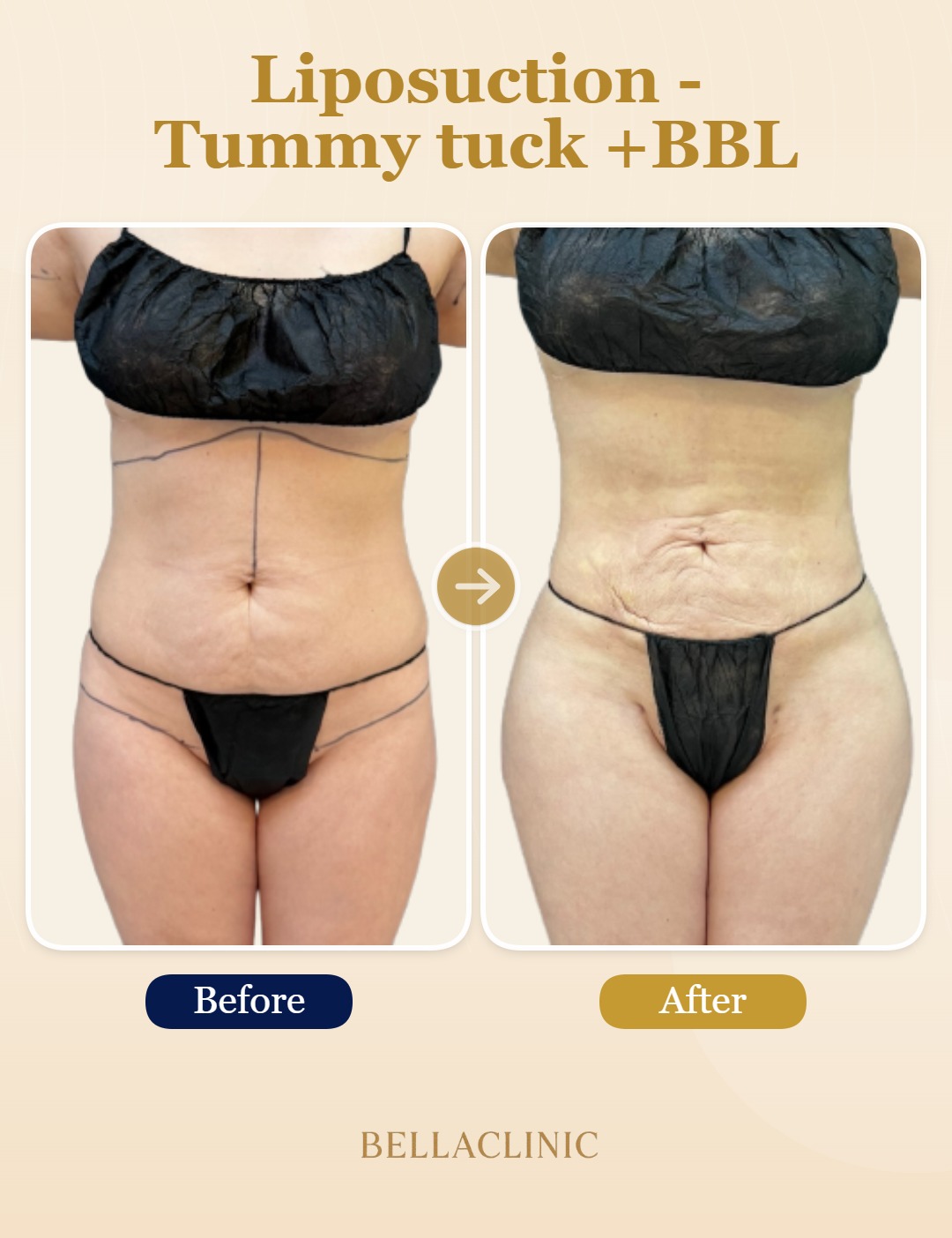 Liposuction - Tummy tuck +BBL