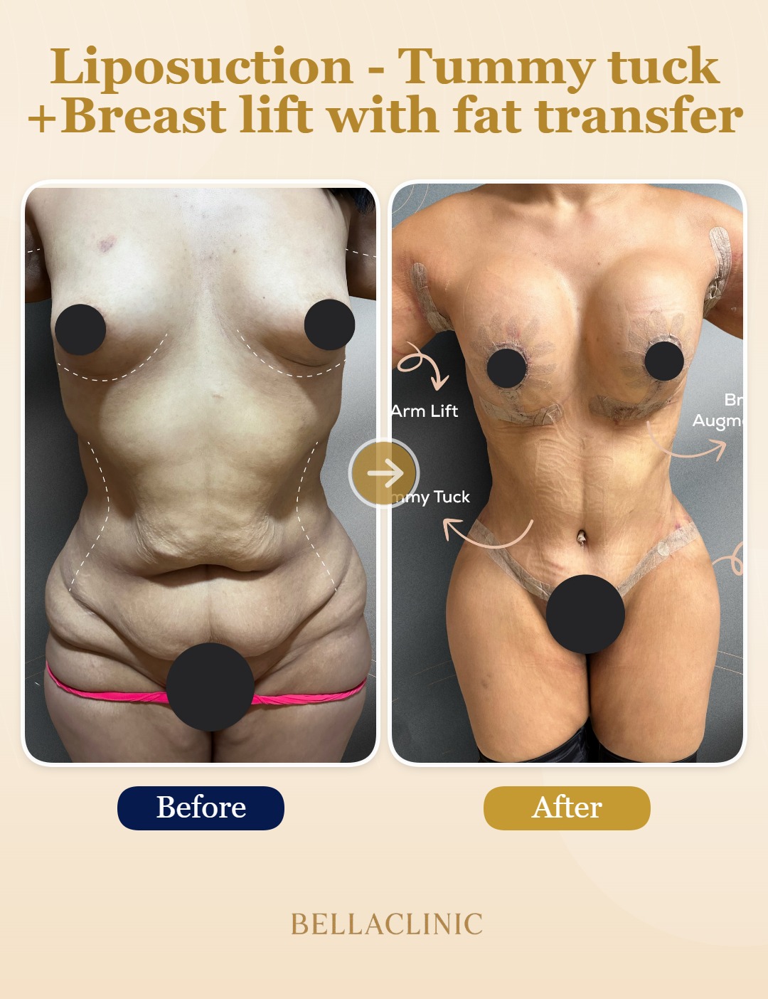 Liposuction - Tummy tuck - Breast lift with  fat transfer