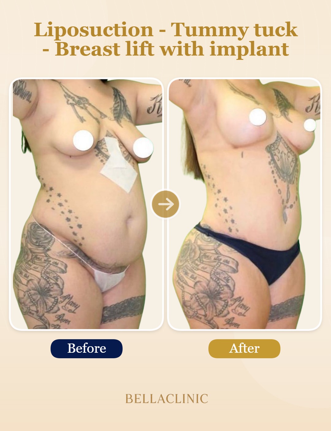 Liposuction - Tummy tuck - Breast lift with implant