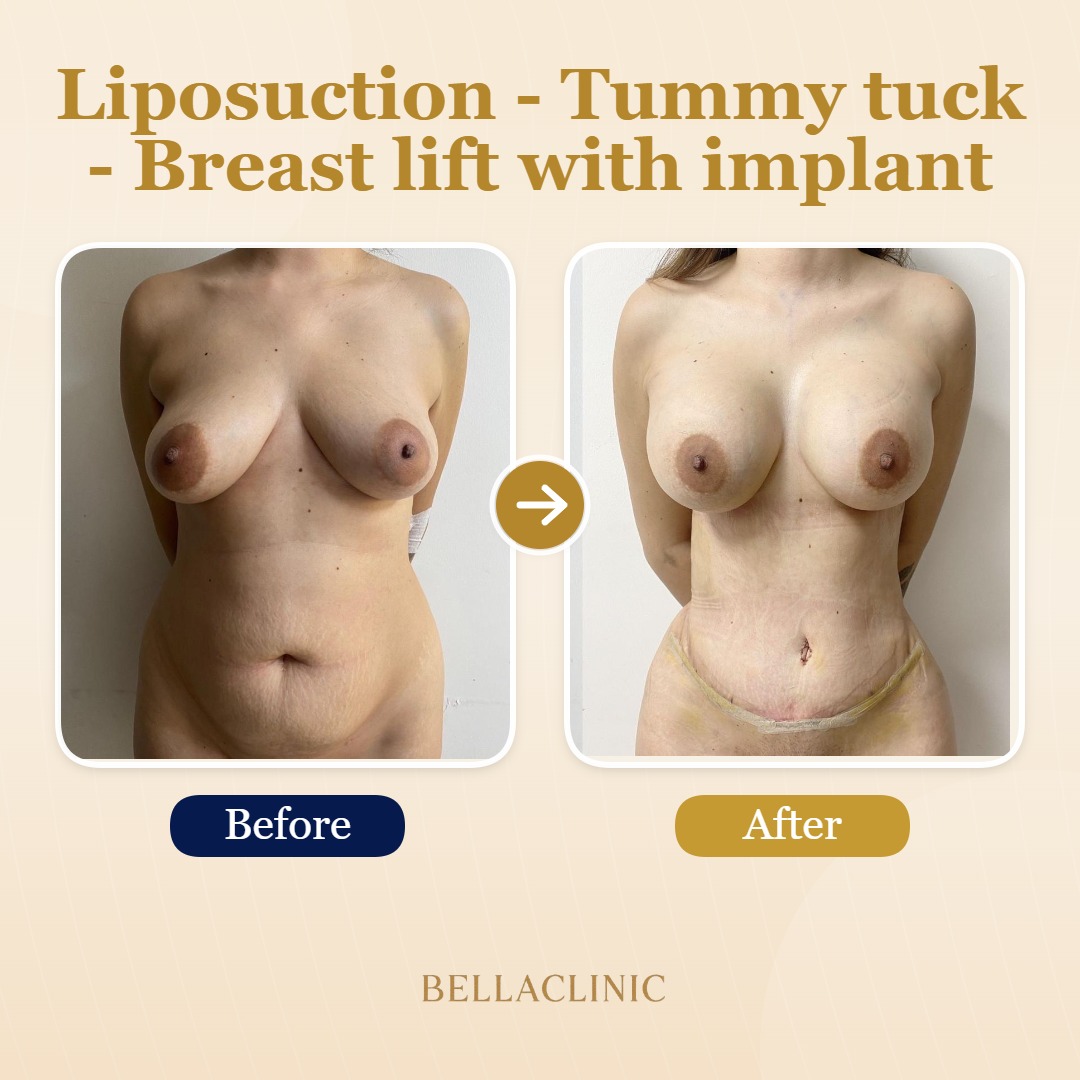 Liposuction - Tummy tuck - Breast lift with implant