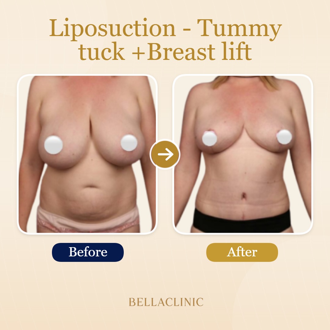 Liposuction - Tummy tuck +Breast lift