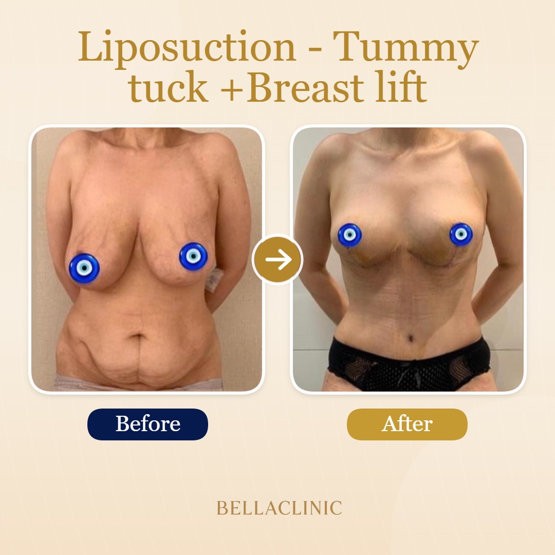 Liposuction - Tummy tuck +Breast lift