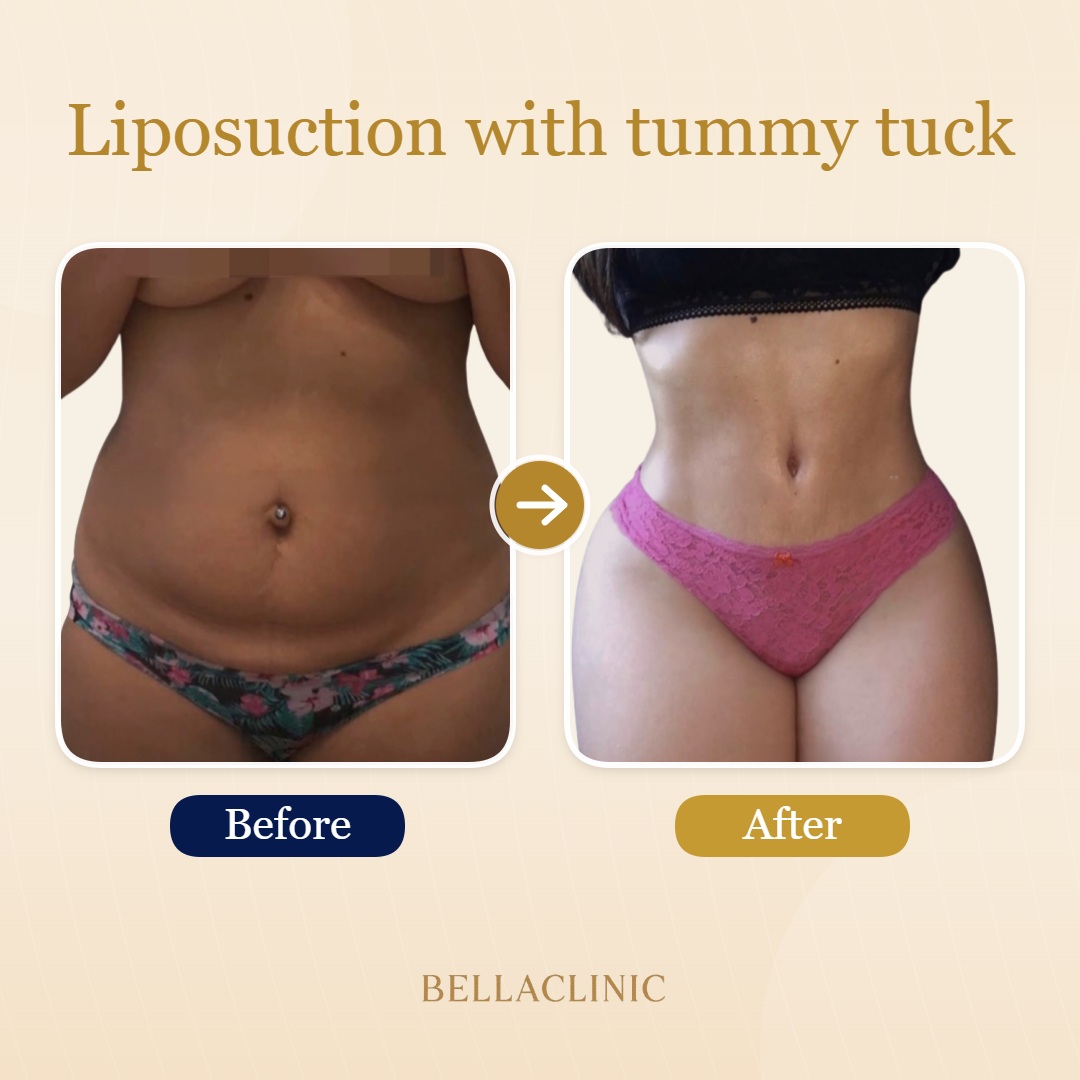 Liposuction with tummy tuck