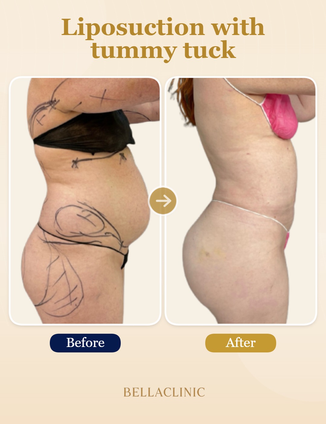 Liposuction with tummy tuck