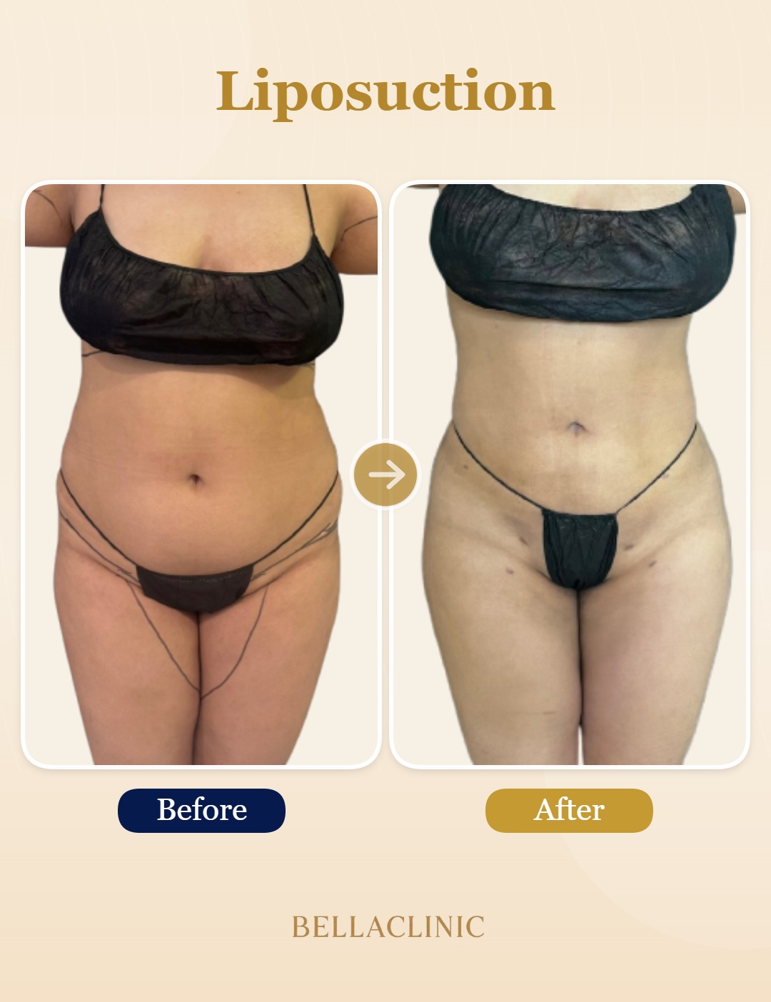 Liposuction