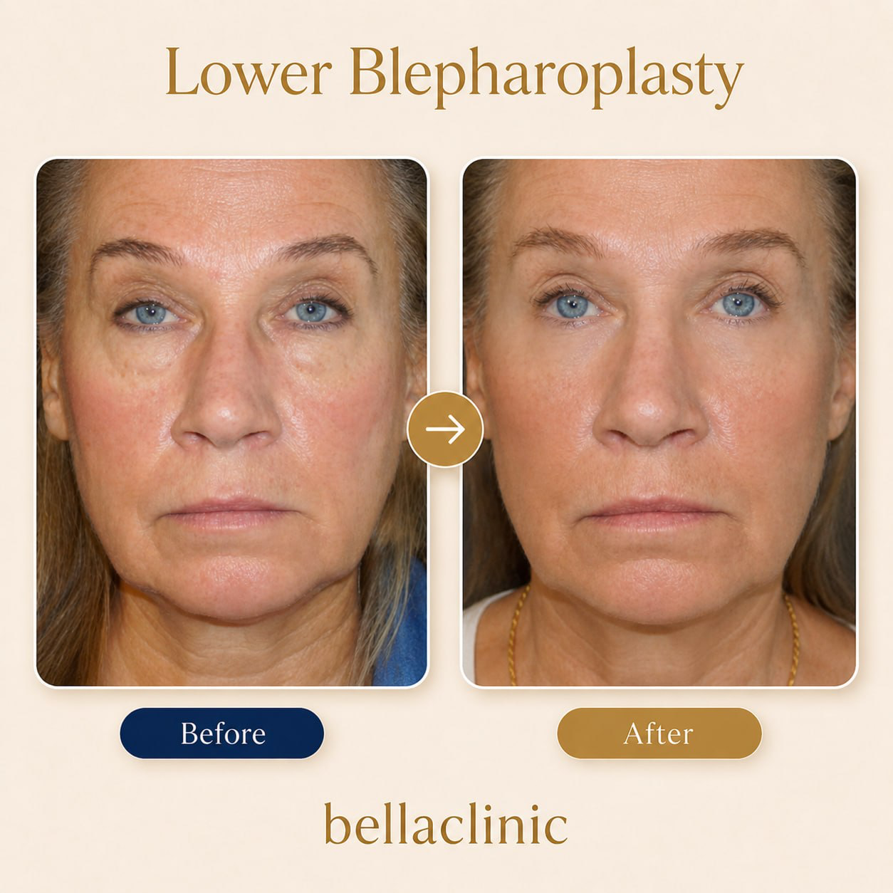 Lower Blepharoplasty