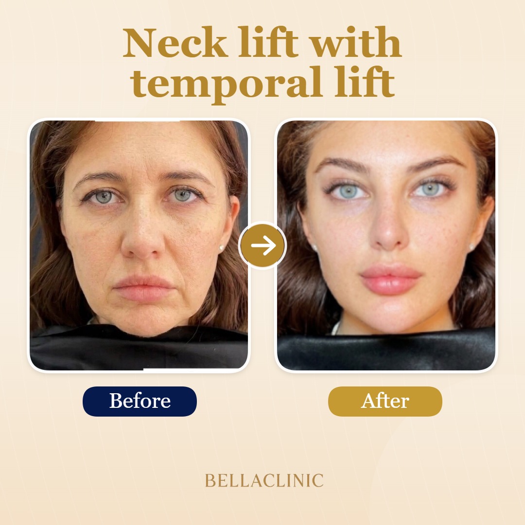 Neck lift with temporal lift