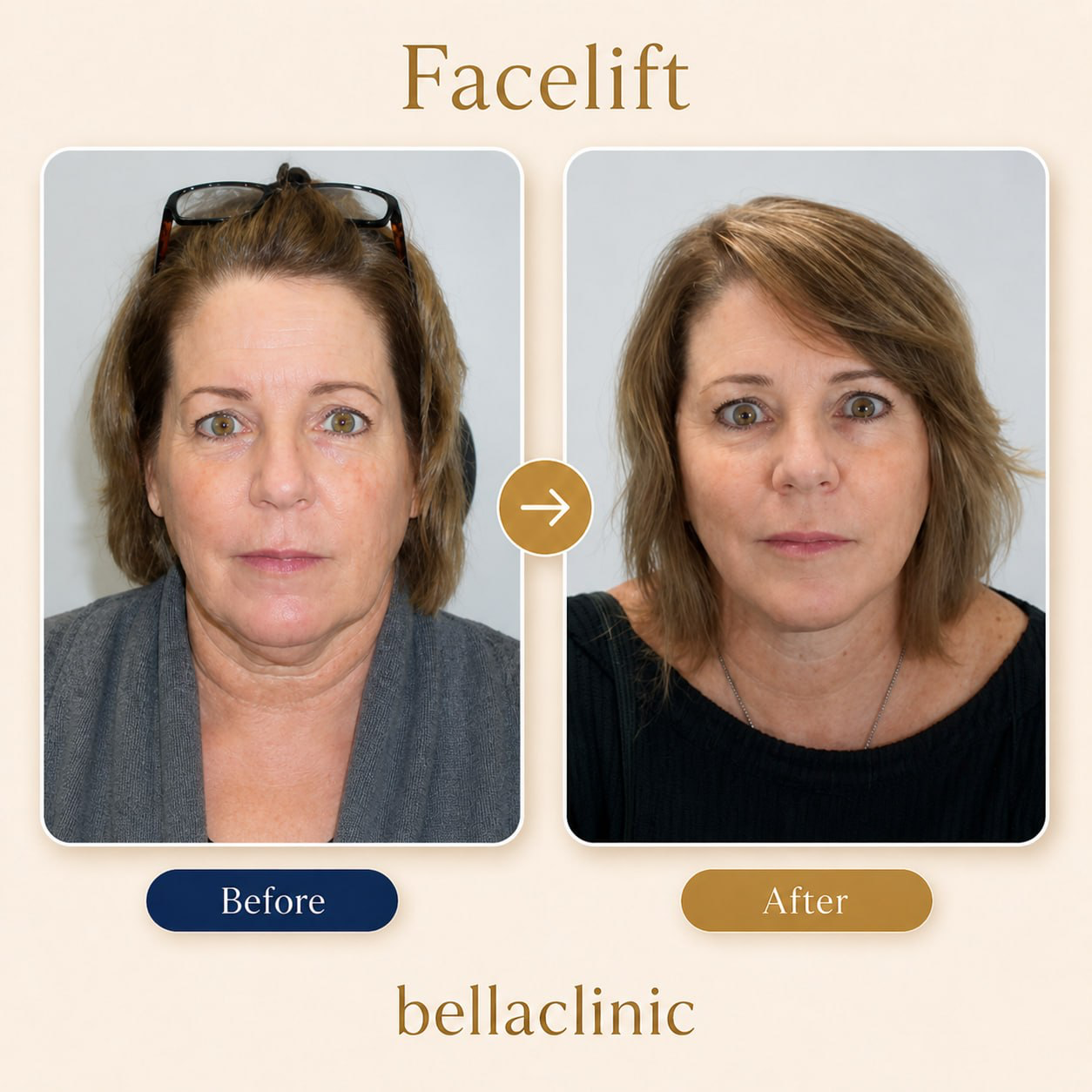 Neck Lift