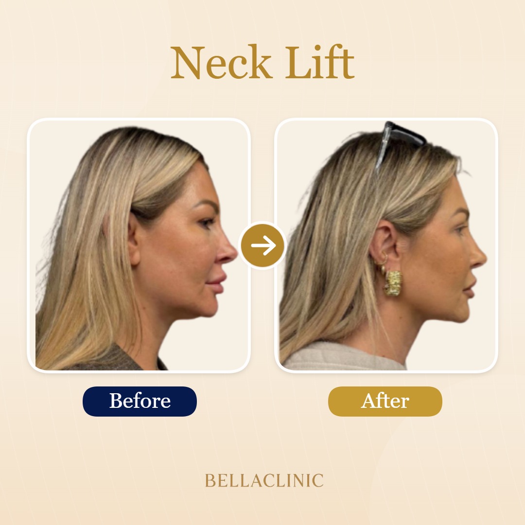 Neck Lift