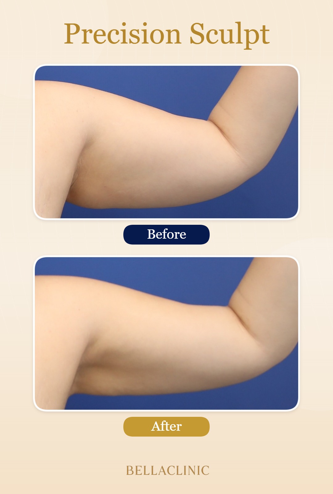 Precision Sculpt