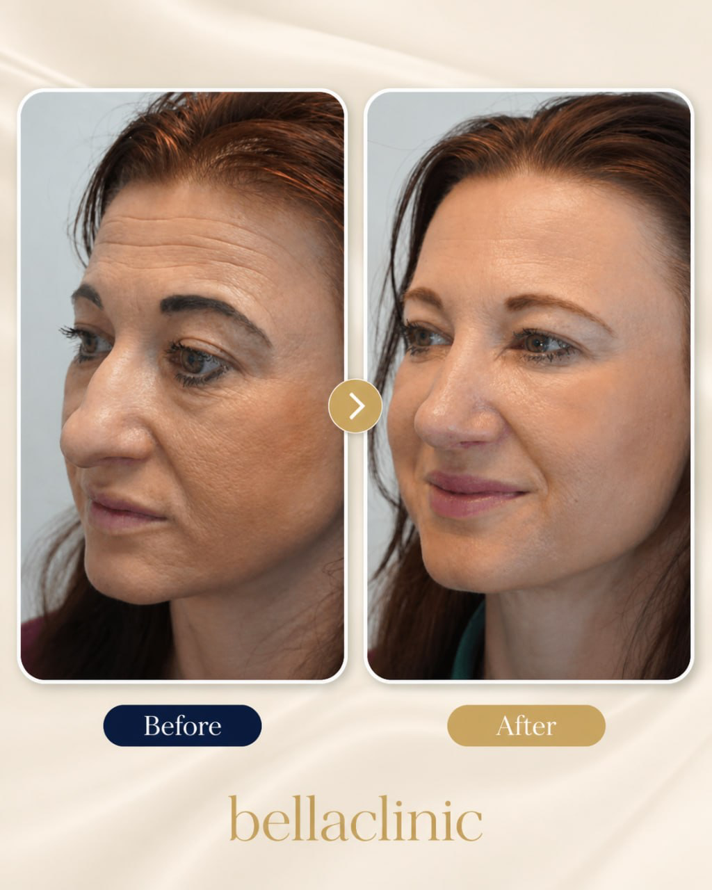Rhinoplasty