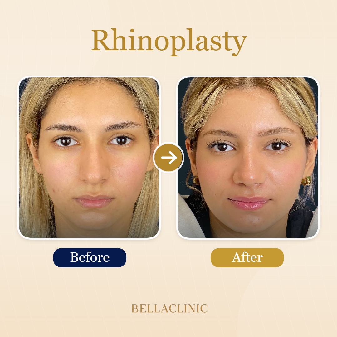 before-after-20260611-142121-iNMrzX.jpg