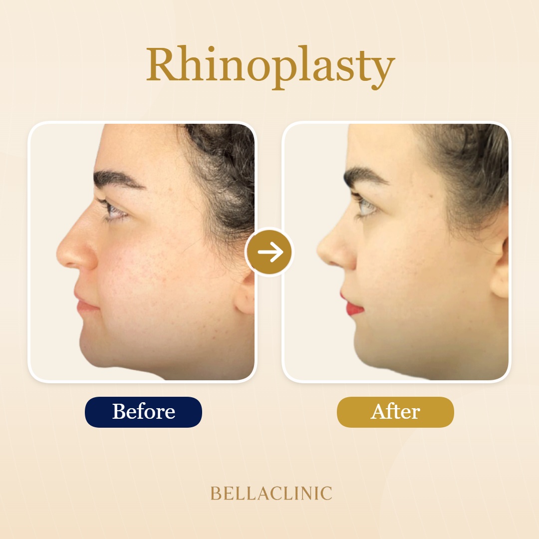 Rhinoplasty