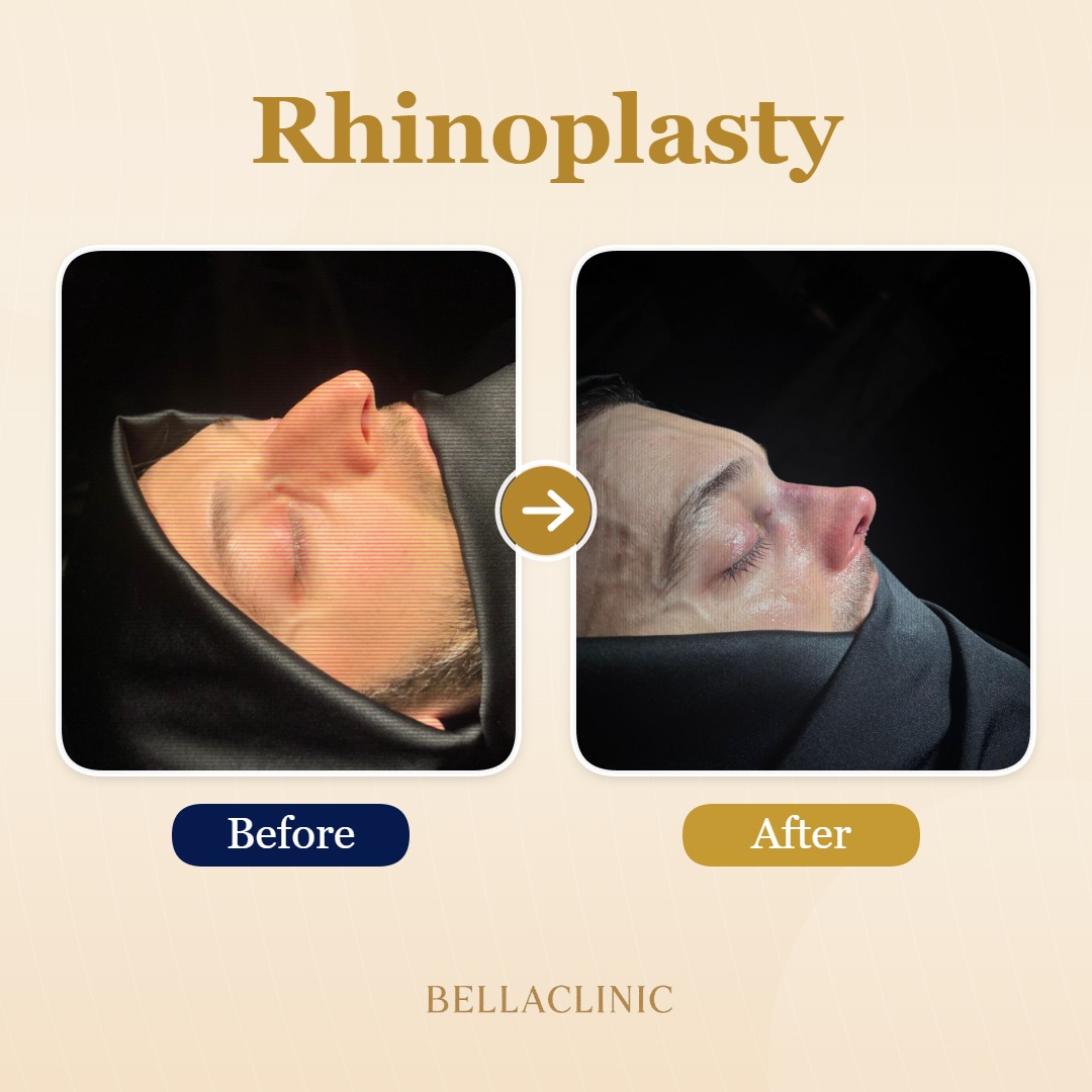 Rhinoplasty