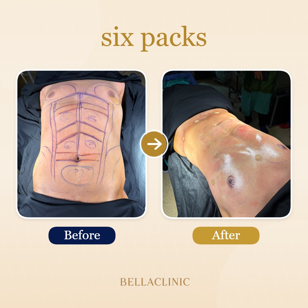 six packs