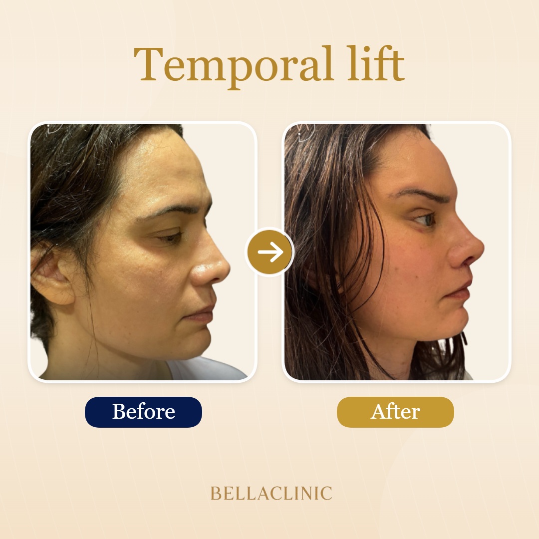 Temporal lift