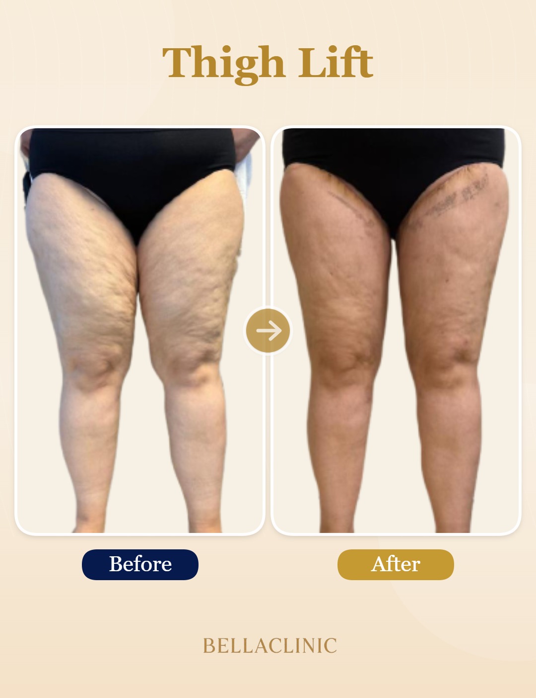 Thigh Lift