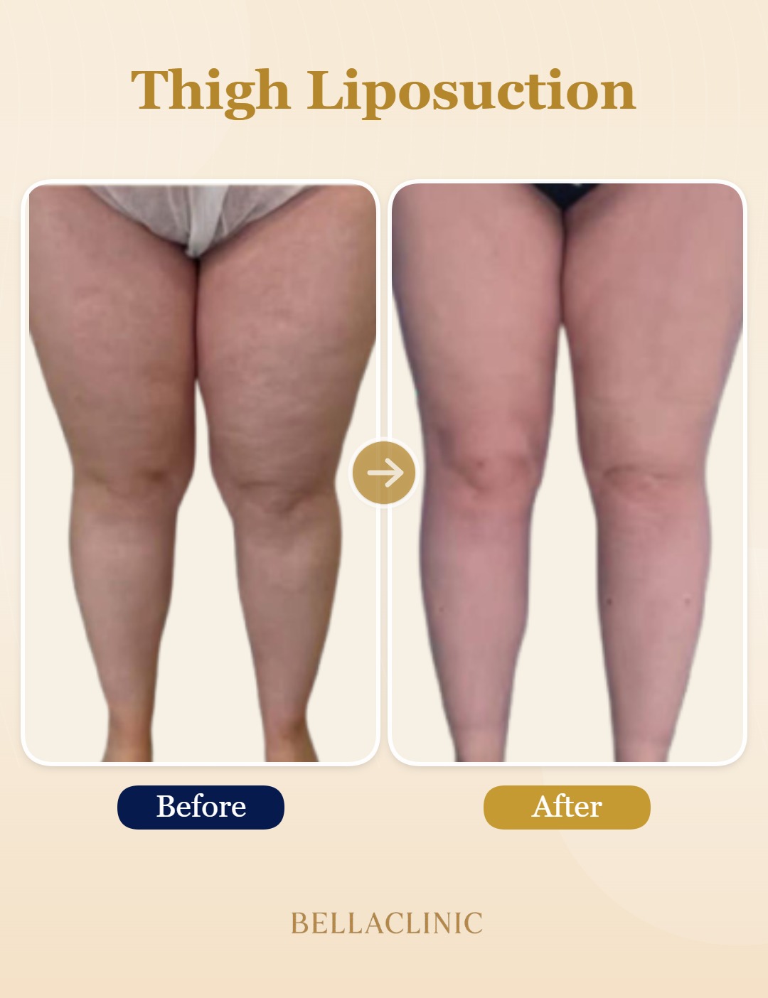 Thigh  Liposuction